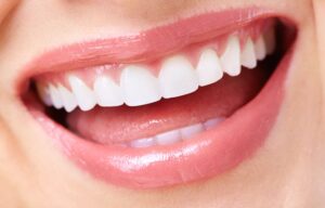 Dental veneers