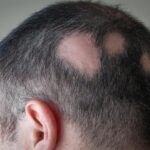 Hair loss