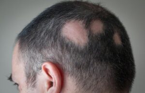 Hair loss