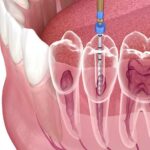 Root canal treatment