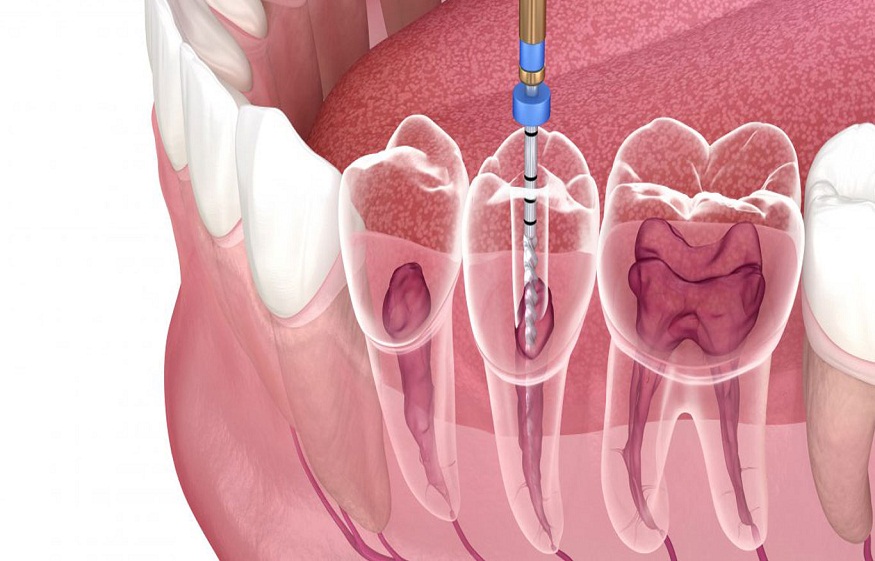 Root canal treatment